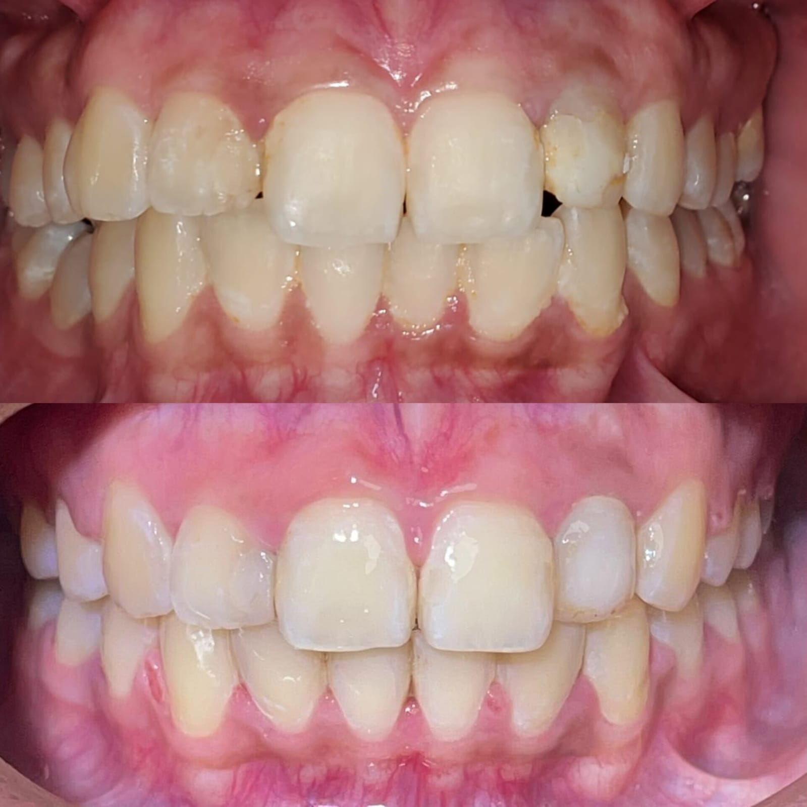 Antes y después de alineación dental