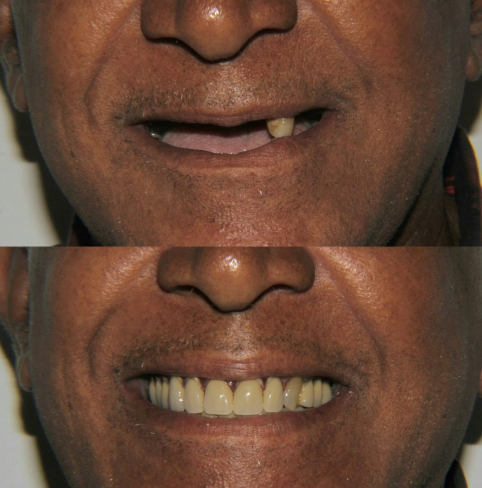 Antes y después de Nueva Sonrisa con prótesis dental